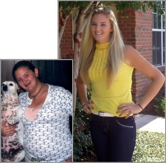 Jacy Adolescent Weight Loss Surgery
