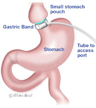 Adjustable Gastric Band