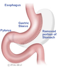 Sleeve Gastrectomy