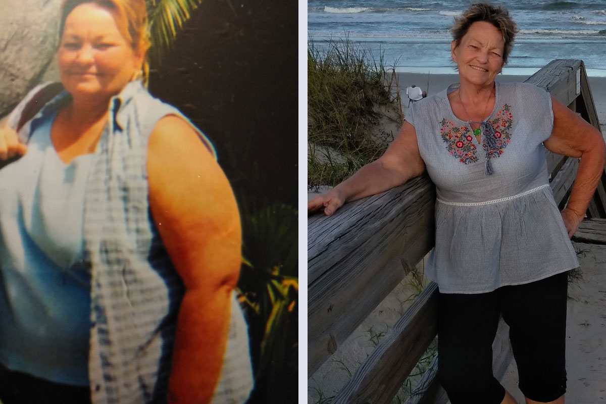 JSAPA Success Story - Gigi before and after surgery