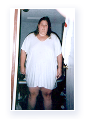 JSAPA Success Story - Tracy before surgery